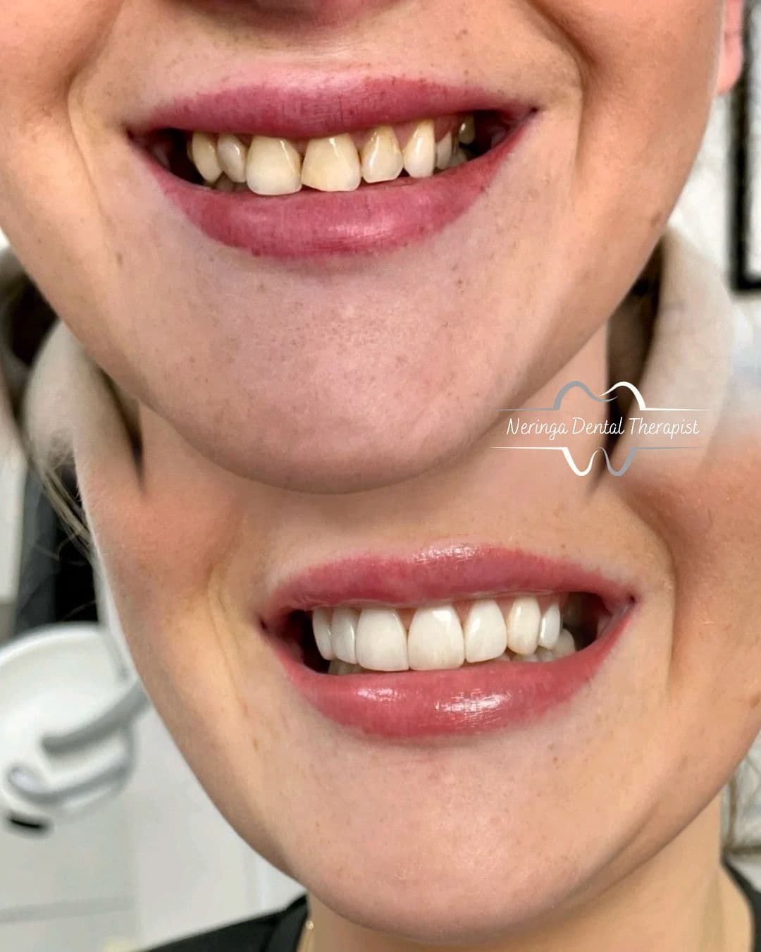 Caries treatment, teeth whitening and composite veneers